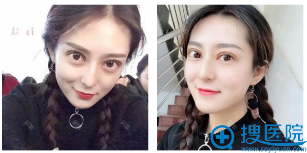 ��ɳ����������˫��Ƥ��ô����4���»ָ�Ч��ͼ����
