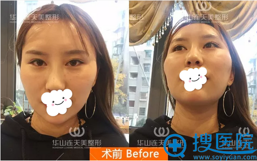 杭州连天美高俊明颧骨打磨+颧弓降低手术全过程及术后效果