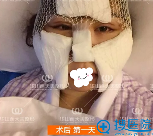 颧骨打磨术+颧弓降低术术后<span style= 颧骨打磨术+颧弓降低术术后<span style=