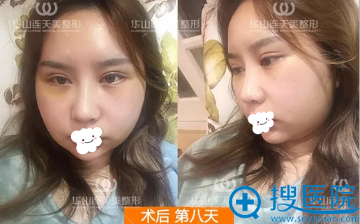 <!--<i data=20240710 data-id=10206></i>-->连天美磨骨术后8天恢复效果 <!--<i data=20240710 data-id=10206></i>-->连天美磨骨术后8天恢复效果