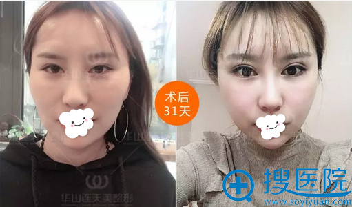 颧骨颧弓术后一个月对比照片 颧骨颧弓术后一个月对比照片