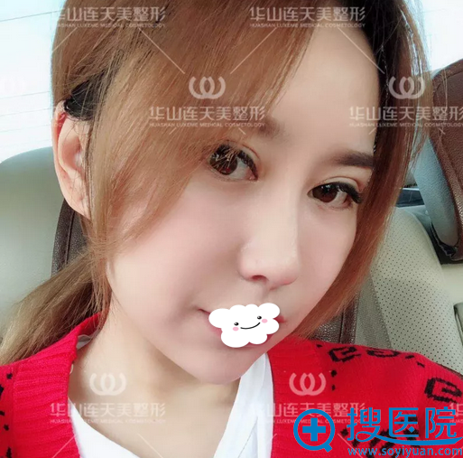 <!--<i data=20240710 data-id=10206></i>-->连天美颧骨缩小手术效果 <!--<i data=20240710 data-id=10206></i>-->连天美颧骨缩小手术效果