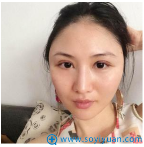 不知不觉找长沙美莱潘卫峰割完双眼皮三天了 不知不觉找长沙美莱潘卫峰割完双眼皮三天了
