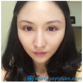 这是我找长沙美莱潘卫峰主任做的双眼皮案例第二天 这是我找长沙美莱潘卫峰主任做的双眼皮案例第二天