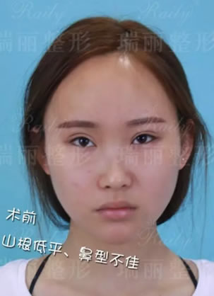 2个月前去芜湖瑞丽整形医院做了双眼皮修复和鼻综合隆鼻手术
