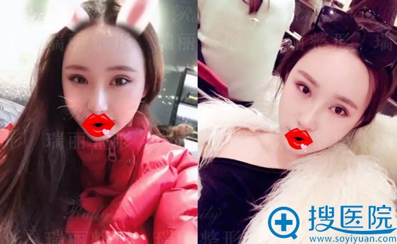 芜湖瑞丽双眼皮修复和隆鼻2周效果 芜湖瑞丽双眼皮修复和隆鼻2周效果