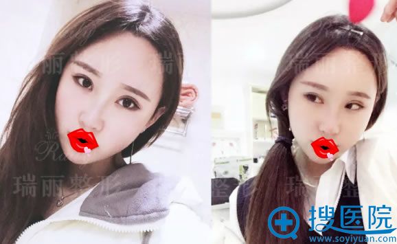 做完双眼皮修复和隆鼻3周恢复图 做完双眼皮修复和隆鼻3周恢复图