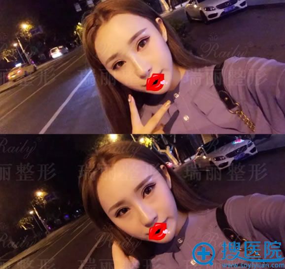 2个月前做双眼皮修复和隆鼻的效果 2个月前做双眼皮修复和隆鼻的效果