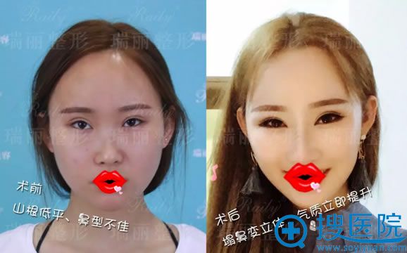 芜湖瑞丽双眼皮修复和隆鼻案例 芜湖瑞丽双眼皮修复和隆鼻案例