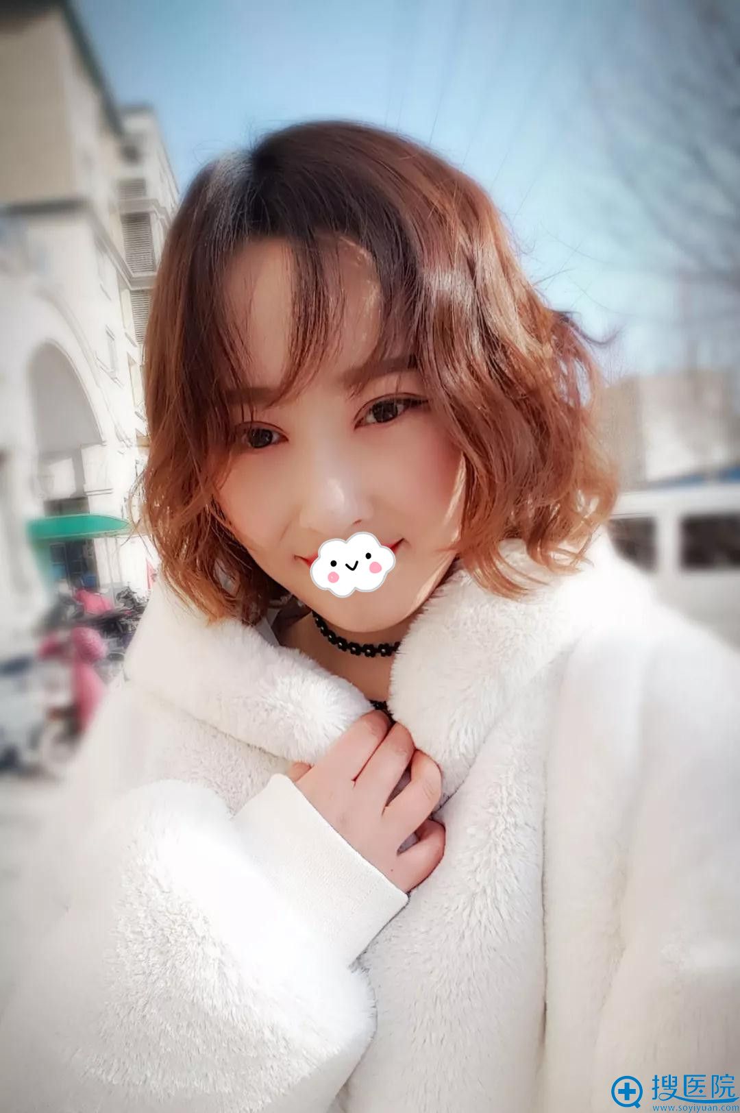 石家庄苏亚美联臣双眼皮术后1月恢复效果 石家庄苏亚美联臣双眼皮术后1月恢复效果