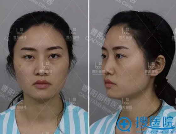 做面部线雕提升前的显老样子 做面部线雕提升前的显老样子