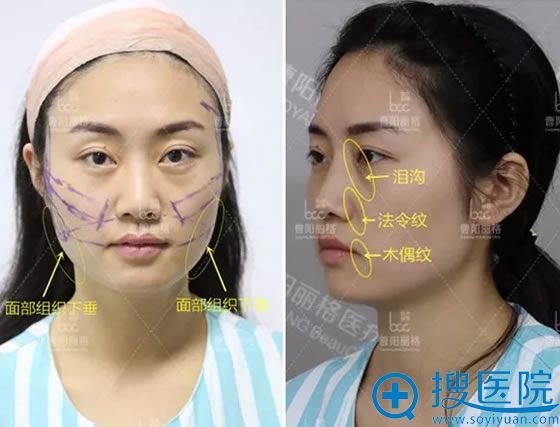 重庆曹阳丽格陈滔线雕手术方案设计 重庆曹阳丽格陈滔线雕手术方案设计