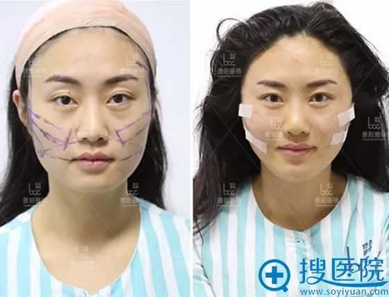 面部线雕刚做完的效果对比图 面部线雕刚做完的效果对比图