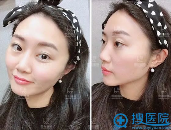 曹阳丽格面部线雕案例3天效果 曹阳丽格面部线雕案例3天效果