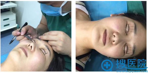 淮北东方美莱坞(伊尔美)吴磊双眼皮手术过程图 淮北东方美莱坞(伊尔美)吴磊双眼皮手术过程图