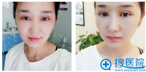 淮北东方美莱坞(伊尔美)双眼皮案例5天效果图 淮北东方美莱坞(伊尔美)双眼皮案例5天效果图