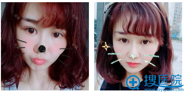 淮北东方美莱坞(伊尔美)做双眼皮怎么样?看吴磊双眼皮案例 淮北东方美莱坞(伊尔美)做双眼皮怎么样?看吴磊双眼皮案例