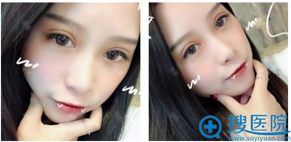合肥红妆整形医院<!--<i data=20240710 data-id=16320></i>-->做双眼皮怎么样?术后五天自拍 合肥红妆整形医院<!--<i data=20240710 data-id=16320></i>-->做双眼皮怎么样?术后五天自拍