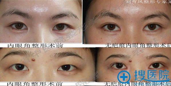 刘育凤开眼角和双眼皮案例图 刘育凤开眼角和双眼皮案例图