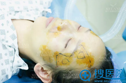 眶隔释放祛眼袋术后即刻效果 眶隔释放祛眼袋术后即刻效果
