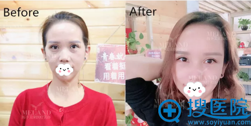 济南历下美莱韩旭祛眼袋+面部脂肪填充术后对比 济南历下美莱韩旭祛眼袋+面部脂肪填充术后对比