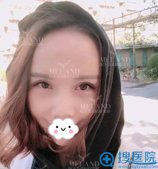 韩旭祛眼袋+面部脂肪填充术后恢复效果 韩旭祛眼袋+面部脂肪填充术后恢复效果