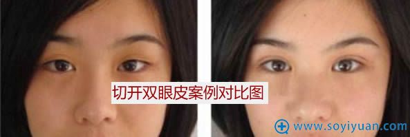 黄金龙切开双眼皮案例效果图 黄金龙切开双眼皮案例效果图