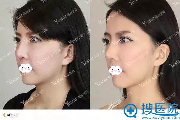 南京艺星隆鼻失败术前术后修复案例 南京艺星隆鼻失败术前术后修复案例