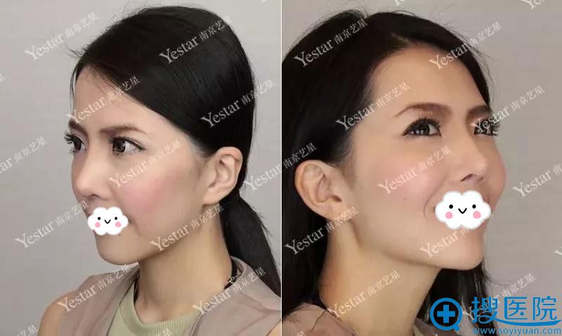 南京艺星隆鼻失败修复效果 南京艺星隆鼻失败修复效果
