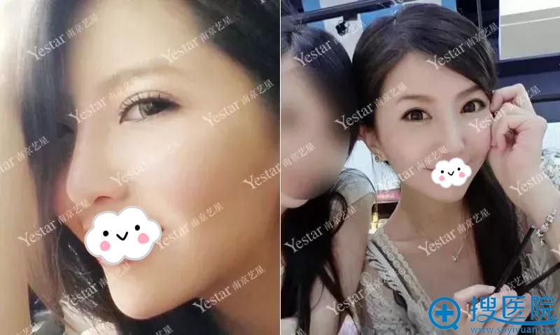 南京艺星隆鼻失败修复成功案例 南京艺星隆鼻失败修复成功案例