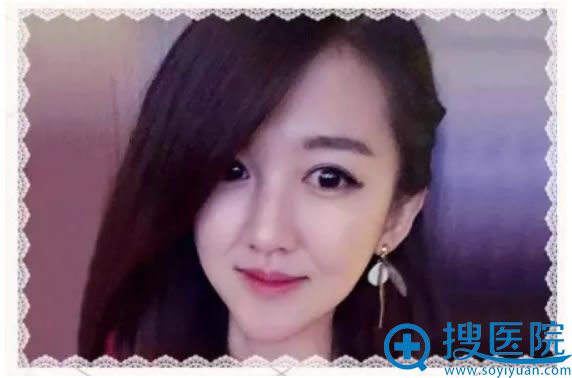找丽都陈三群做双眼皮30天效果 找丽都陈三群做双眼皮30天效果