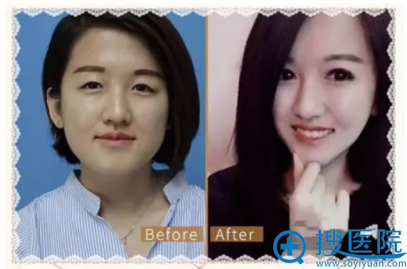金华丽都陈三群双眼皮案例对比图 金华丽都陈三群双眼皮案例对比图
