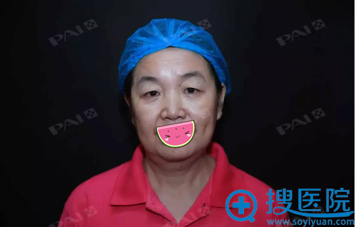 深圳鹏爱面部线雕提升术前照 深圳鹏爱面部线雕提升术前照