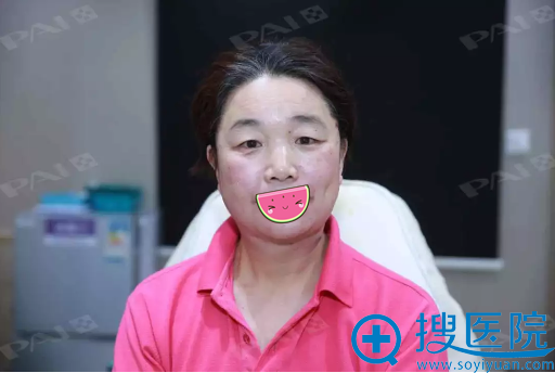 深圳鹏爱整形关宇面部线雕提升术后即刻效果 深圳鹏爱整形关宇面部线雕提升术后即刻效果