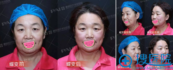 深圳鹏爱关宇线雕提升术后多角度对比 深圳鹏爱关宇线雕提升术后多角度对比