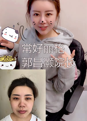 北京常好丽格郭昌灏医生为我做面部吸脂和鼻综合恢复效果很赞