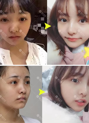 重庆妹子告诉你重庆华美何春涛耳软骨+膨体鼻综合案例效果如何