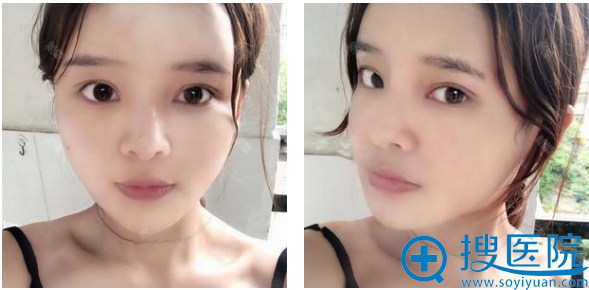 这是在南宁梦想做完脂肪填充3天的样子 这是在南宁梦想做完脂肪填充3天的样子