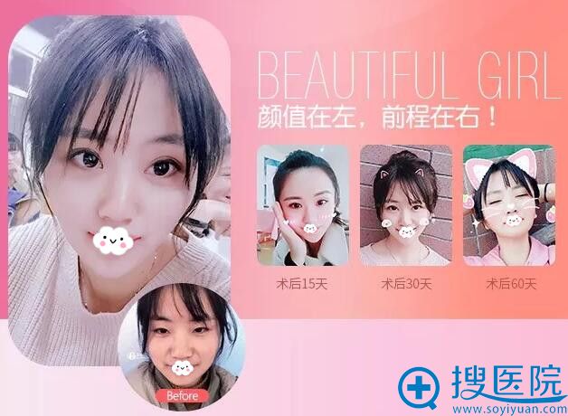 太原时光真人眼鼻整形效果前后对比 太原时光真人眼鼻整形效果前后对比