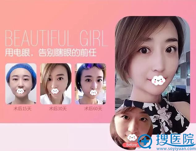 太原时光整形双眼皮真人案例 太原时光整形双眼皮真人案例
