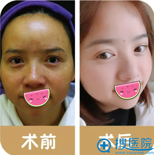 贵阳华美祛黄褐斑+嫩肤治疗真实经历 见证皮秒祛斑的神奇效果