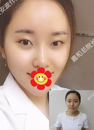 在北京嘉和咨询线雕和雷达线雕哪个好及看真人效果 决定做线雕