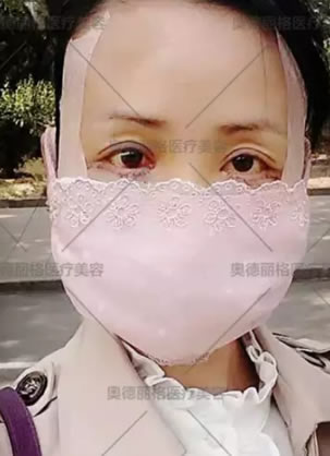 北京奥德丽格王志军不明注射物奥美定取出成功案例过程及效果