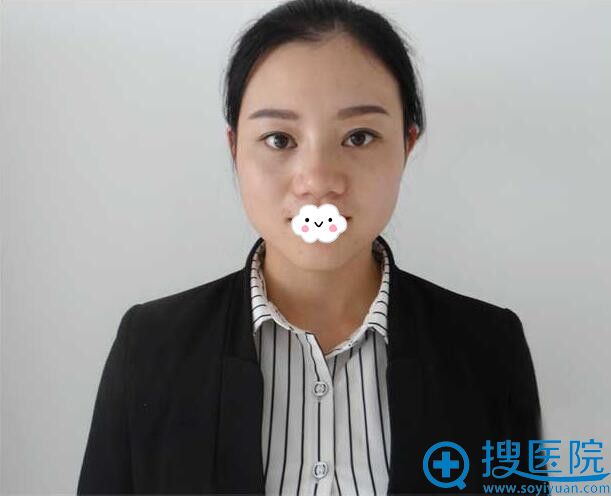 对鼻型不满意到信阳东方艺做了假体隆鼻 15天后我的气质真变了