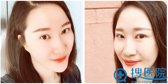 <!--<i data=20240710 data-id=12669></i>-->王新东做双眼皮怎么样?双眼皮案例半年效果图 <!--<i data=20240710 data-id=12669></i>-->王新东做双眼皮怎么样?双眼皮案例半年效果图
