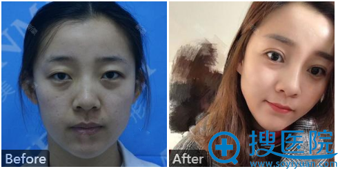 哈尔滨臻美整形医院王丹丹切开双眼皮案例 哈尔滨臻美整形医院王丹丹切开双眼皮案例