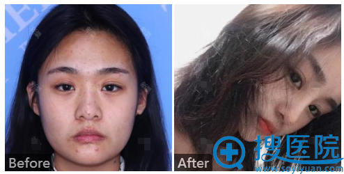哈尔滨臻美整形医院王丹丹鼻综合隆鼻案例 哈尔滨臻美整形医院王丹丹鼻综合隆鼻案例