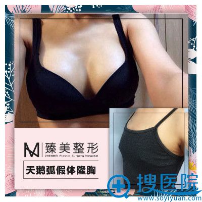 哈尔滨臻美整形医院<!--<i data=20240710 data-id=16623></i>-->假体隆胸案例 哈尔滨臻美整形医院<!--<i data=20240710 data-id=16623></i>-->假体隆胸案例