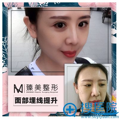 哈尔滨臻美整形医院王丹丹面部线雕提升案例 哈尔滨臻美整形医院王丹丹面部线雕提升案例