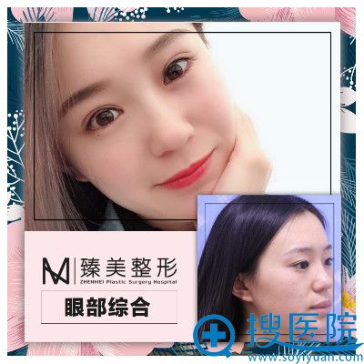 哈尔滨臻美整形医院王丹丹怎么样?双眼皮案例对比图 哈尔滨臻美整形医院王丹丹怎么样?双眼皮案例对比图